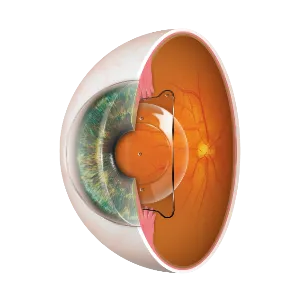 EVO ICL - Sitz im Auge 