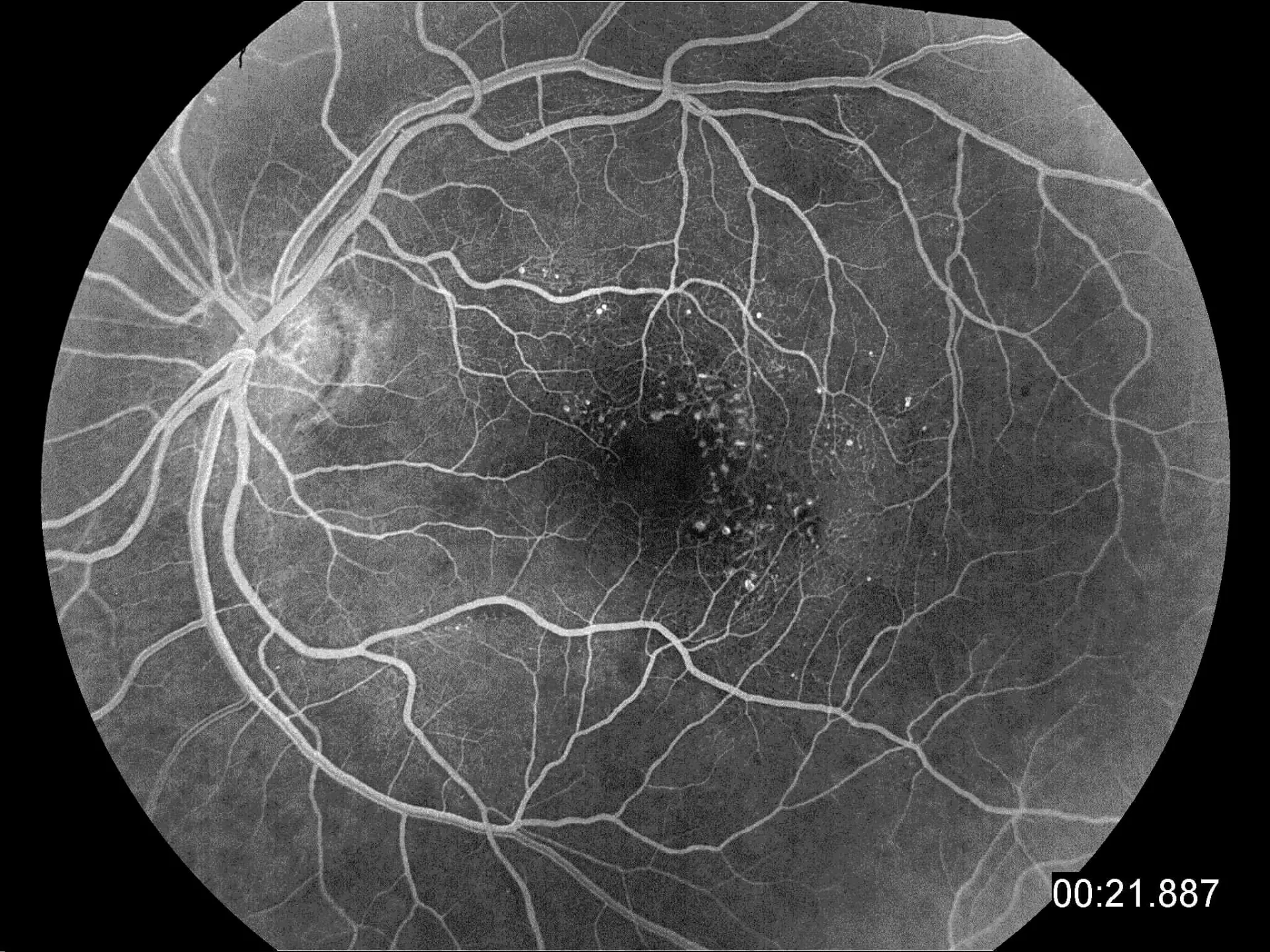 Fluoreszeinangiografie - Gefäßaussackungen in der Netzhautmitte