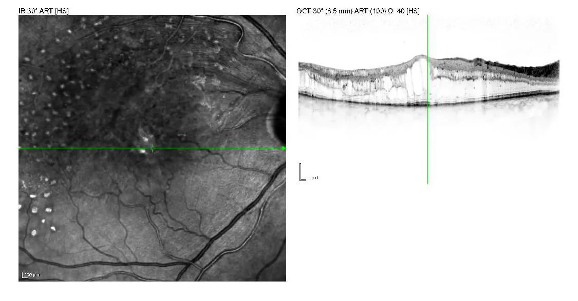 Gefäßverschlüsse - Verschuss eines Venenastes mit Makulaödem Optische Kohärenztomografie