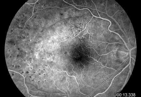 Gefäßverschlüsse - Verschluss eines oberen Venenastes Fluoreszeinangiografie