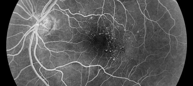 Fluoreszeinangiografie - Gefäßaussackungen in der Netzhautmitte